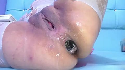 Media: Video of a baby's face with a large, shiny, red, swollen eye, possibly from an infection or injury, lying on a light blue padded surface.